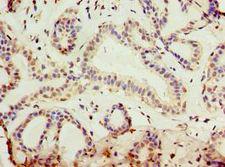 KLF3 Antibody - Immunohistochemistry of paraffin-embedded human breast cancer using antibody at 1:100 dilution.