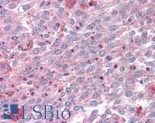 KLF4 Antibody - Anti-KLF4 antibody IHC of human melanoma. Immunohistochemistry of formalin-fixed, paraffin-embedded tissue after heat-induced antigen retrieval. Antibody concentration 5 ug/ml.  This image was taken for the unconjugated form of this product. Other forms have not been tested.