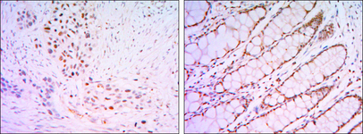 KLF4 Antibody - IHC of paraffin-embedded lung cancer tissues (left) and human rectum tissues (right) using KLF4 mouse monoclonal antibody with DAB staining.