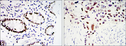 KLF4 Antibody - IHC of paraffin-embedded colon cancer tissues (left) and lung cancer tissues (right) using KLF4 mouse monoclonal antibody with DAB staining