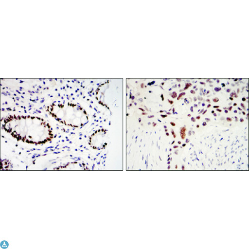 KLF4 Antibody - Immunohistochemistry (IHC) analysis of paraffin-embedded colon cancer tissues (left) and Lung Cancer Tissues (right) with DAB staining using GKLF Monoclonal Antibody.