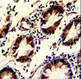 KLF4 Antibody - Formalin-fixed and paraffin-embedded human colon carcinoma with KLF4 Antibody, which was peroxidase-conjugated to the secondary antibody, followed by DAB staining. This data demonstrates the use of this antibody for immunohistochemistry; clinical relevance has not been evaluated.