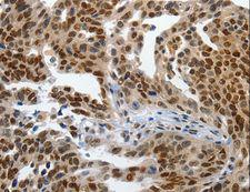 KLF5 / BTEB2 Antibody - Immunohistochemistry of paraffin-embedded Human ovarian cancer using KLF5 Polyclonal Antibody at dilution of 1:120.