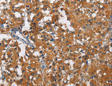 KLF7 Antibody - Immunohistochemistry of paraffin-embedded Human thyroid cancer using KLF7 Polyclonal Antibody at dilution of 1:60.