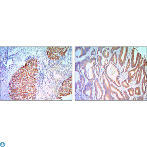 KLHL11 Antibody - Immunohistochemistry (IHC) analysis of paraffin-embedded liver cancer (right) and colon cancer tissues (left) with DAB staining using KLHL11 Monoclonal Antibody.