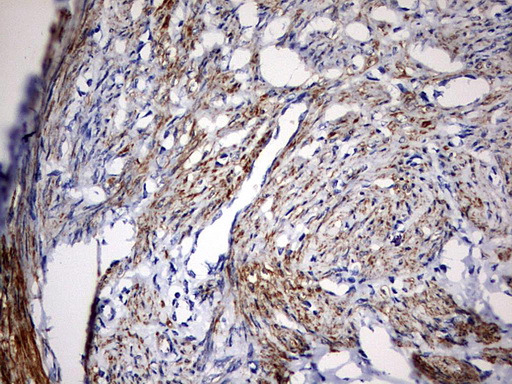 KLHL12 Antibody - IHC of paraffin-embedded Adenocarcinoma of Human endometrium tissue using anti-KLHL12 mouse monoclonal antibody. (Heat-induced epitope retrieval by 10mM citric buffer, pH6.0, 120°C for 3min).