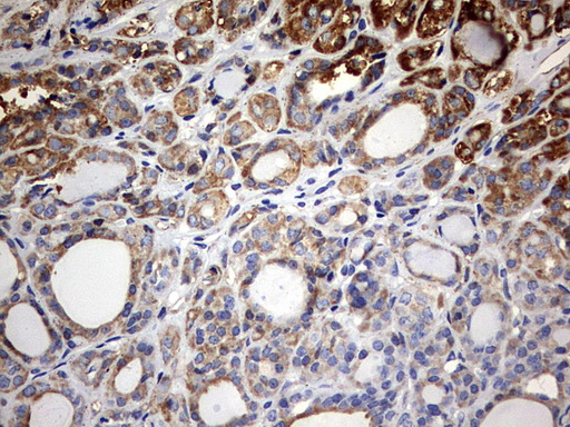 KLHL12 Antibody - IHC of paraffin-embedded Carcinoma of Human thyroid tissue using anti-KLHL12 mouse monoclonal antibody. (Heat-induced epitope retrieval by 10mM citric buffer, pH6.0, 120°C for 3min).