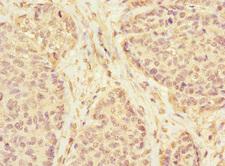 KLHL13 Antibody - Immunohistochemistry of paraffin-embedded human ovarian cancer at dilution 1:100