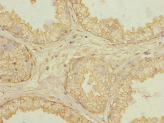 KLHL13 Antibody - Immunohistochemistry of paraffin-embedded human prostata cancer at dilution 1:100