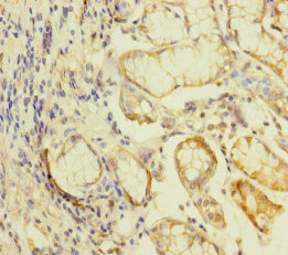 KLHL26 Antibody - Immunohistochemistry of paraffin-embedded human gastric cancer at dilution of 1:100