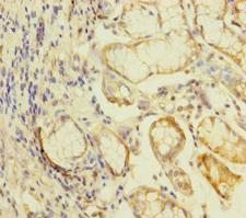 KLHL26 Antibody - Immunohistochemistry of paraffin-embedded human gastric cancer at dilution of 1:100