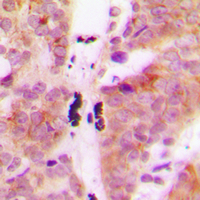 KLHL29 Antibody - Immunohistochemical analysis of KLHL29 staining in human breast cancer formalin fixed paraffin embedded tissue section. The section was pre-treated using heat mediated antigen retrieval with sodium citrate buffer (pH 6.0). The section was then incubated with the antibody at room temperature and detected using an HRP conjugated compact polymer system. DAB was used as the chromogen. The section was then counterstained with hematoxylin and mounted with DPX.