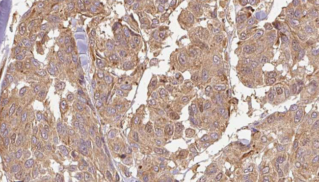 KLHL3 Antibody - 1:100 staining human Melanoma tissue by IHC-P. The sample was formaldehyde fixed and a heat mediated antigen retrieval step in citrate buffer was performed. The sample was then blocked and incubated with the antibody for 1.5 hours at 22°C. An HRP conjugated goat anti-rabbit antibody was used as the secondary.