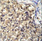 KLHL35 Antibody - KLHL35 Antibody immunohistochemistry of formalin-fixed and paraffin-embedded human breast carcinoma followed by peroxidase-conjugated secondary antibody and DAB staining.