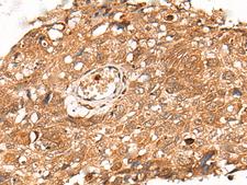 KLHL36 Antibody - Immunohistochemistry of paraffin-embedded Human lung cancer tissue  using KLHL36 Polyclonal Antibody at dilution of 1:55(×200)