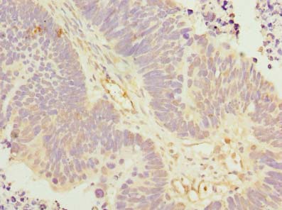 KLHL42 / KLHDC5 Antibody - Immunohistochemistry of paraffin-embedded human ovarian cancer using antibody at dilution of 1:100.
