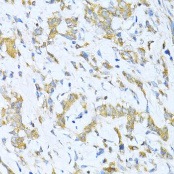 KLHL42 / KLHDC5 Antibody - Immunohistochemistry of paraffin-embedded Human gastric cancer using KLHL42 Polyclonal Antibody at dilution of 1:100 (40x lens).