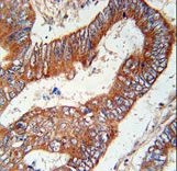 KLHL6 Antibody - KLHL6 Antibody immunohistochemistry of formalin-fixed and paraffin-embedded human colon carcinoma followed by peroxidase-conjugated secondary antibody and DAB staining.