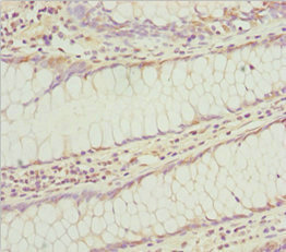 KLHL7 Antibody - Immunohistochemistry of paraffin-embedded human colon cancer at dilution 1:100