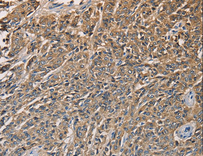KLK1 / Kallikrein 1 Antibody - Immunohistochemistry of paraffin-embedded Human liver cancer using KLK1 Polyclonal Antibody at dilution of 1:40.