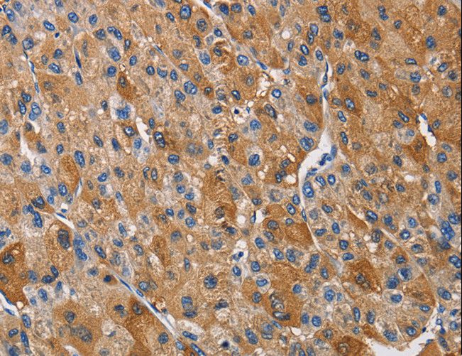 KLK1 / Kallikrein 1 Antibody - Immunohistochemistry of paraffin-embedded Human prostate cancer using KLK1 Polyclonal Antibody at dilution of 1:40.