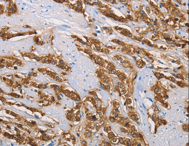 KLK1 / Kallikrein 1 Antibody - Immunohistochemistry of paraffin-embedded Human prostate cancer using KLK1 Polyclonal Antibody at dilution of 1:40.
