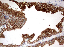 KLK2 / Kallikrein 2 Antibody - IHC of paraffin-embedded Human prostate tissue using anti-KLK2 mouse monoclonal antibody. (Heat-induced epitope retrieval by 10mM citric buffer, pH6.0, 120°C for 3min).