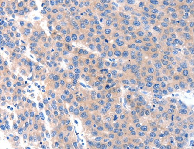 KLK2 / Kallikrein 2 Antibody - Immunohistochemistry of paraffin-embedded Human ovarian cancer using KLK2 Polyclonal Antibody at dilution of 1:100.