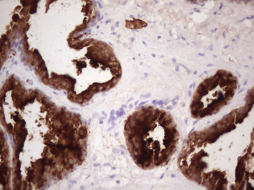 KLK3 / PSA Antibody - Immunohistochemical staining of paraffin-embedded Carcinoma of Human prostate tissue using anti-KLK3 mouse monoclonal antibody. (Heat-induced epitope retrieval by 1 mM EDTA in 10mM Tris, pH8.5, 120C for 3min. (1:150)