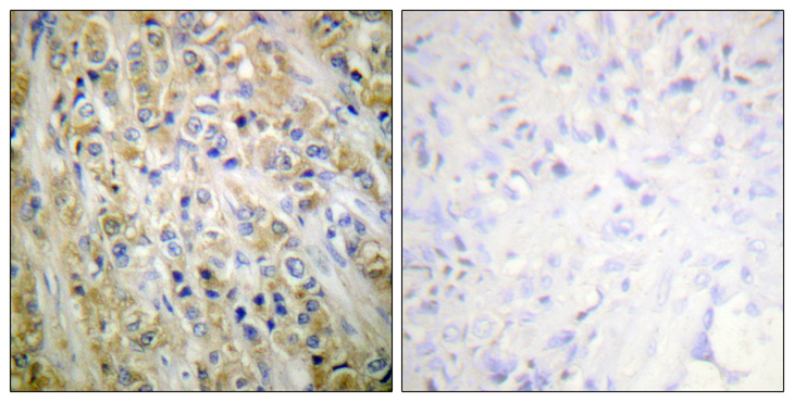 KLK3 / PSA Antibody - Immunohistochemistry analysis of paraffin-embedded human prostate carcinoma tissue, using Prostate-specific Antigen Antibody. The picture on the right is blocked with the synthesized peptide.