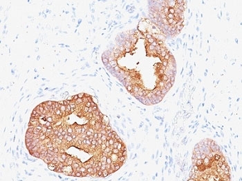 KLK3 / PSA Antibody - Formalin-fixed, paraffin-embedded human prostate carcinoma stained with Prostate Specific Antigen antibody (1A7).  This image was taken for the unmodified form of this product. Other forms have not been tested.