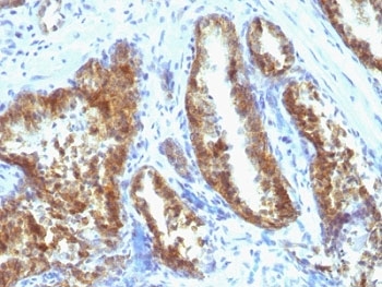 KLK3 / PSA Antibody - Formalin-fixed, paraffin-embedded human prostate carcinoma stained with Prostate Specific Antigen antibody (A67-B/E3 + 1A7).  This image was taken for the unmodified form of this product. Other forms have not been tested.