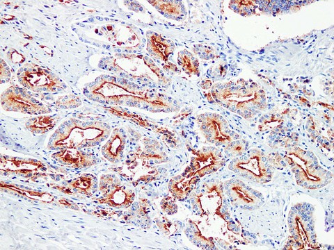 KLK3 / PSA Antibody - Prostatic Carcinoma 1