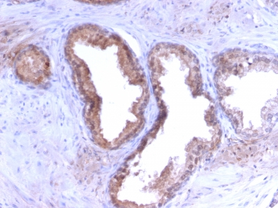 KLK3 / PSA Antibody - Formalin-fixed, paraffin-embedded human Prostate Carcinoma stained with PSA Rabbit Recombinant Monoclonal Antibody (KLK3/2871R).