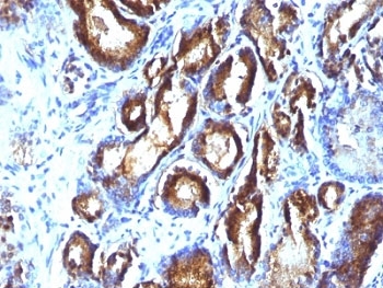 KLK3 / PSA Antibody - Formalin-fixed, paraffin-embedded human prostate carcinoma stained with PSA antibody (KLK3/801 + KLK3/1248).  This image was taken for the unmodified form of this product. Other forms have not been tested.