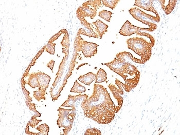 KLK3 / PSA Antibody - PSA antibody immunohistochemistry clone KLK3/801.  This image was taken for the unmodified form of this product. Other forms have not been tested.