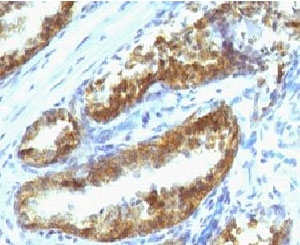 KLK3 / PSA Antibody - IHC testing of human prostate carcinoma with Prostate Specific antibody (PSAK3-1).  This image was taken for the unmodified form of this product. Other forms have not been tested.