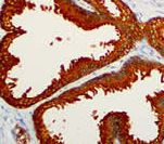 KLK3 / PSA Antibody - IHC of Prostate-Specific Antigen on FFPE Prostatic Adenocarcinoma tissue. This image was taken for the unmodified form of this product. Other forms have not been tested.