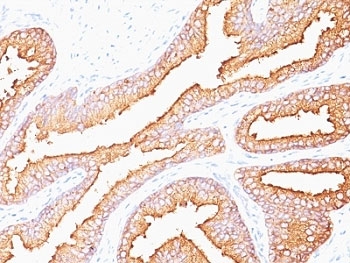 KLK3 / PSA Antibody - Formalin-fixed, paraffin-embedded human prostate carcinoma stained with PSA antibody (SPM352).  This image was taken for the unmodified form of this product. Other forms have not been tested.