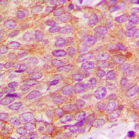 KLK3 / PSA Antibody - Immunohistochemical analysis of Kallikrein 3 staining in human breast cancer formalin fixed paraffin embedded tissue section. The section was pre-treated using heat mediated antigen retrieval with sodium citrate buffer (pH 6.0). The section was then incubated with the antibody at room temperature and detected using an HRP conjugated compact polymer system. DAB was used as the chromogen. The section was then counterstained with hematoxylin and mounted with DPX.