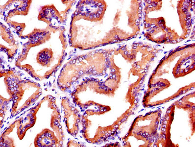 KLK3 / PSA Antibody - IHC image of KLK3 Antibody diluted at 1:600 and staining in paraffin-embedded human prostate tissue performed on a Leica BondTM system. After dewaxing and hydration, antigen retrieval was mediated by high pressure in a citrate buffer (pH 6.0). Section was blocked with 10% normal goat serum 30min at RT. Then primary antibody (1% BSA) was incubated at 4°C overnight. The primary is detected by a biotinylated secondary antibody and visualized using an HRP conjugated SP system.