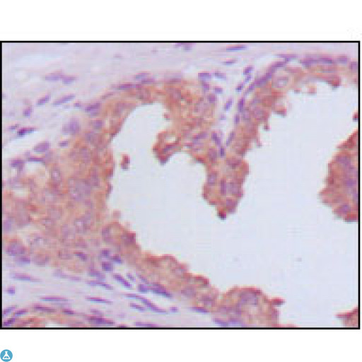 KLK3 / PSA Antibody - Immunohistochemistry (IHC) analysis of paraffin-embedded human prostate carcinoma tissues, showing cytoplasmic localization with DAB staining using PSA Monoclonal Antibody.