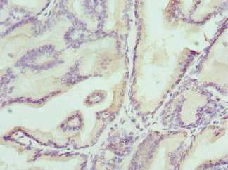 KLK4 / Kallikrein 4 Antibody - Immunohistochemistry of paraffin-embedded human prostate cancer at dilution 1:100