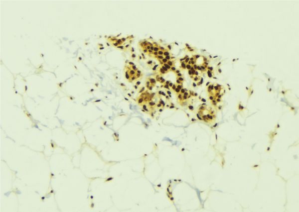 KLK6 / Kallikrein 6 Antibody - 1:100 staining human breast carcinoma tissue by IHC-P. The sample was formaldehyde fixed and a heat mediated antigen retrieval step in citrate buffer was performed. The sample was then blocked and incubated with the antibody for 1.5 hours at 22°C. An HRP conjugated goat anti-rabbit antibody was used as the secondary.