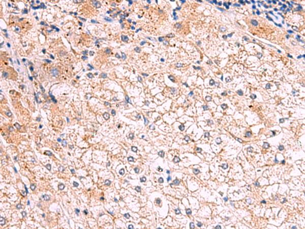 KLK9 / Kallikrein 9 Antibody - Immunohistochemistry of paraffin-embedded Human liver cancer tissue  using KLK9 Polyclonal Antibody at dilution of 1:50(×200)