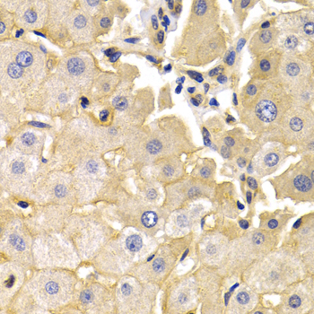 KLKB1 / Plasma Kallikrein Antibody - Immunohistochemistry of paraffin-embedded human liver cancer tissue.