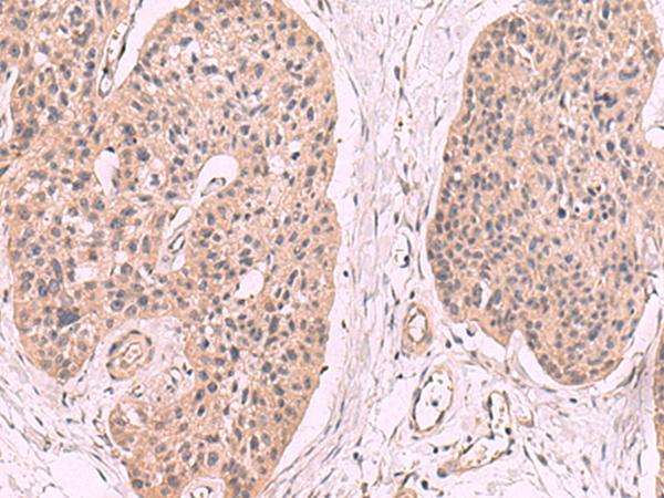KLRB1 / CD161 Antibody - Immunohistochemistry of paraffin-embedded Human esophagus cancer tissue  using KLRB1 Polyclonal Antibody at dilution of 1:55(×200)