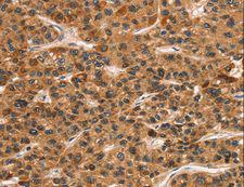 KLRC1 / NKG2A / CD159a Antibody - Immunohistochemistry of paraffin-embedded Human gastric cancer using KLRC1 Polyclonal Antibody at dilution of 1:30.