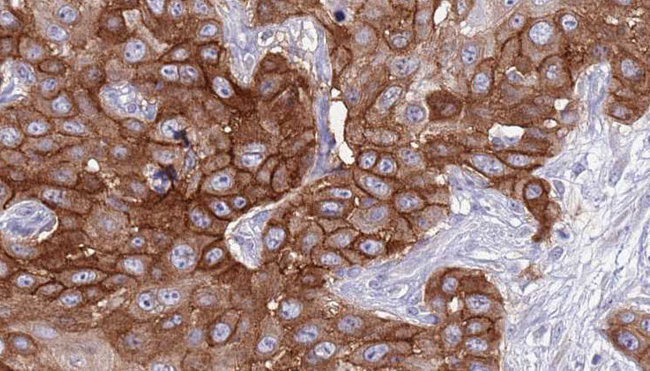 KLRD1 / CD94 Antibody - 1:100 staining human Head and neck carcinoma tissue by IHC-P. The sample was formaldehyde fixed and a heat mediated antigen retrieval step in citrate buffer was performed. The sample was then blocked and incubated with the antibody for 1.5 hours at 22°C. An HRP conjugated goat anti-rabbit antibody was used as the secondary.