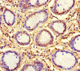 KLRG1 Antibody - Immunohistochemistry of paraffin-embedded human gastric cancer using KLRG1 Antibody at dilution of 1:100